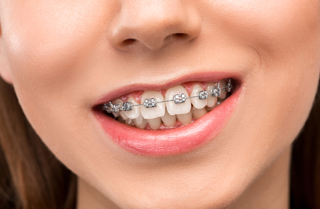 aparat-dentar-fix-metalic Aparat dentar fix metalic
