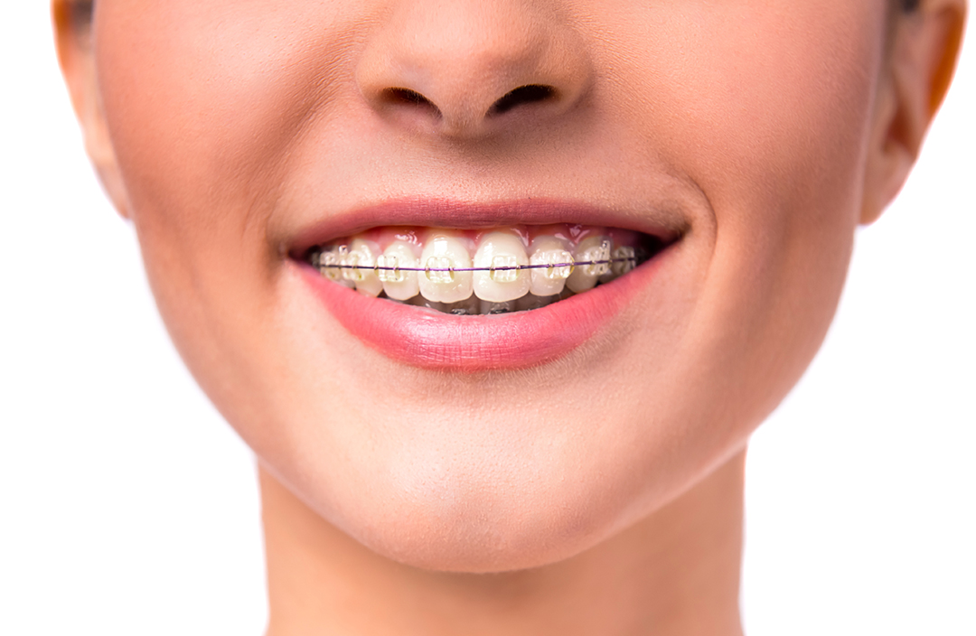aparat-dentar-fix-safir Aparat dentar fix safir
