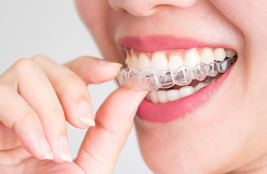 aparat-dentar-invizibil Aparat dentar invizibil