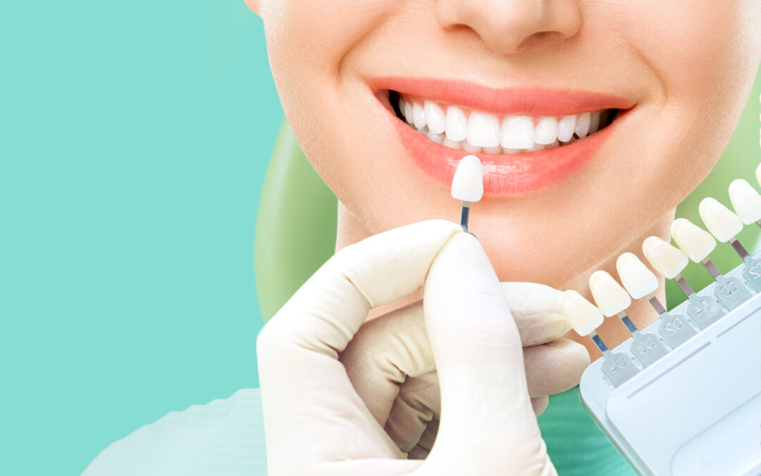 Tot ce trebuie sa stii despre fatetele dentare