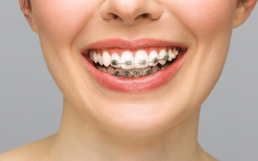 Cum previi problemele dintilor cand porti aparat dentar?