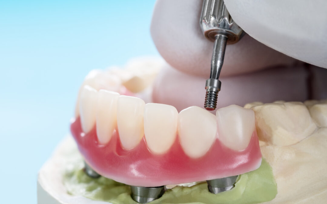 Sistemul de implant dentar All-on-4