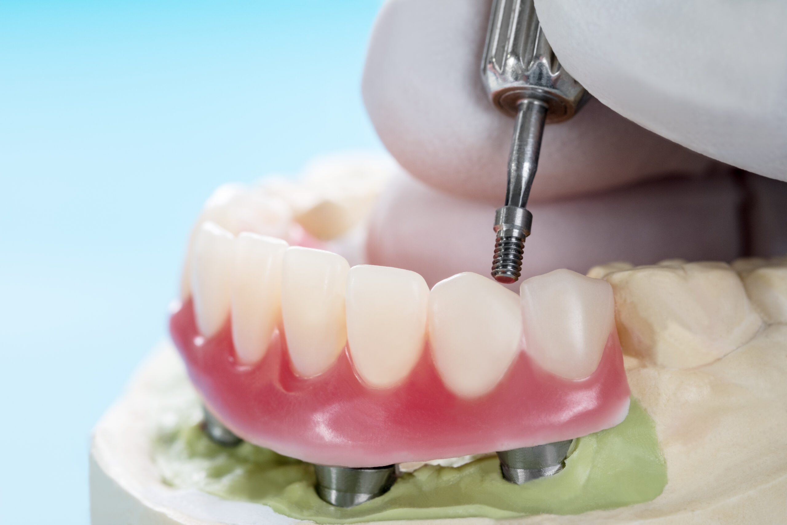 Протезирование зубов в казани. Несъемные протезы зубов. Не съёмные зубные протезы. Несъемный протез на имплантах.