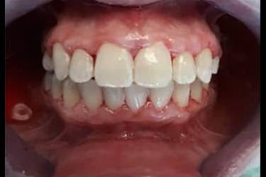 Pacient aparat dentar