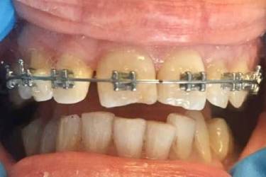 Pacient aparat dentar