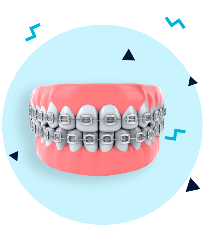 cum-functioneaza-un-aparat-dentar Cum functioneaza un aparat dentar
