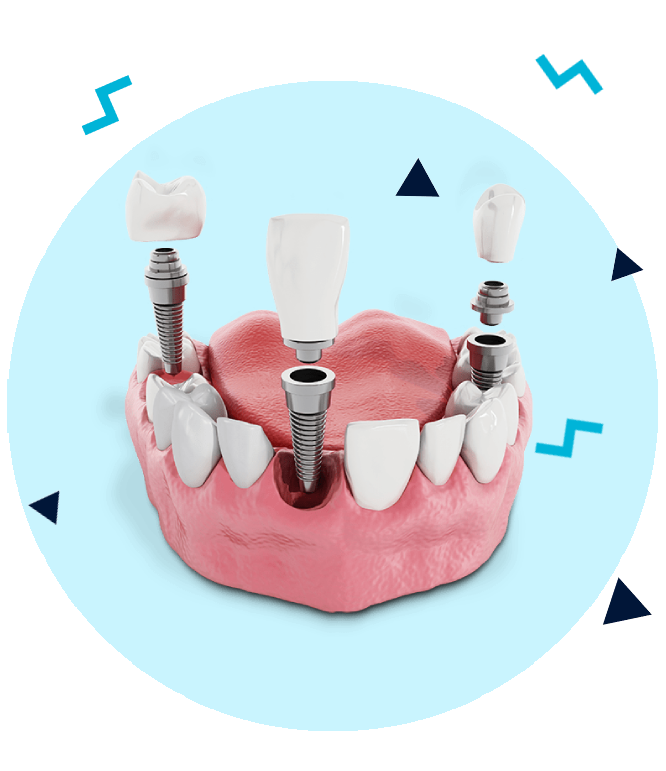 Implant dentar avantaje & beneficii