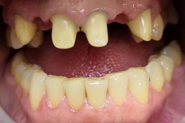 Pacient implant dentar