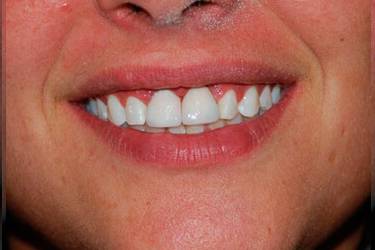 Pacient implant dentar