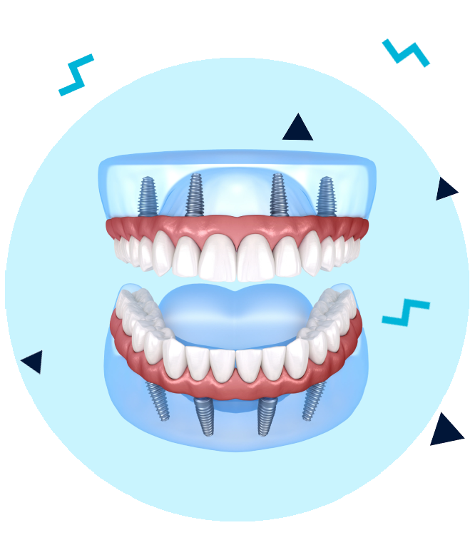 Proteze dentare fixe All-on-4 / All-on-6