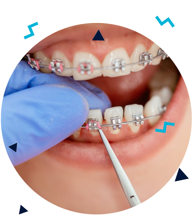 Tipuri de aparate dentare