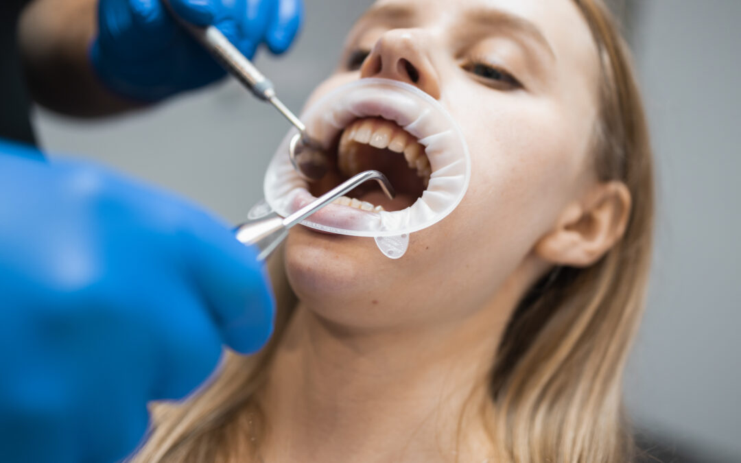 Beneficiile detartrajului dentar
