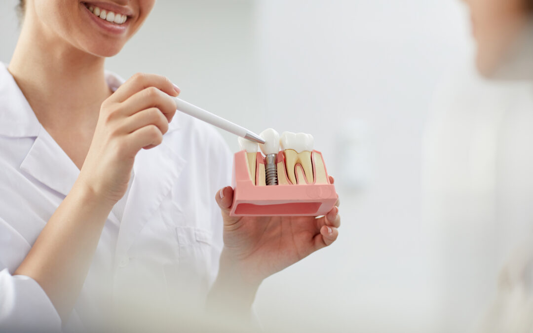 Implantul dentar – cea mai sigura solutie de inlocuire a dintelui natural