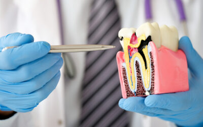 Tratamentul de canal – solutia pentru a pastra cat mai mult dintii naturali
