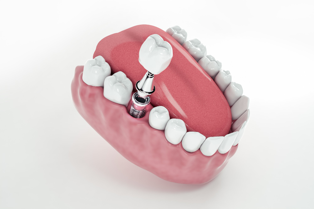Complicatiile si contraindicatiile si implanturilor dentare