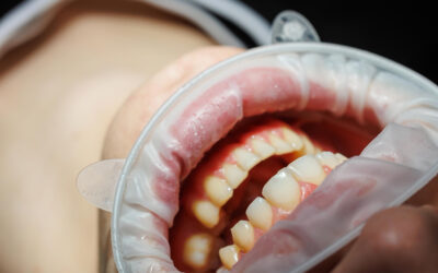 Chiuretajul subgingival in tratamentul parodontozei