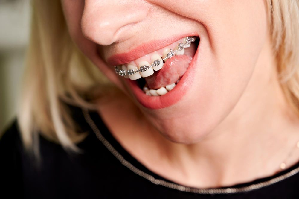 Urgentele ortodontice: 12 motive sa mergi rapid la medic