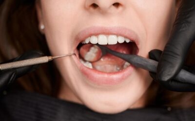 Sigilarea dentara. Ce este si ce eficienta are?