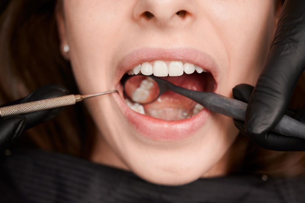 Sigilarea dentara. Ce este si ce eficienta are?