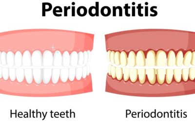 Bolile gingivale. Gingivita si parodontita