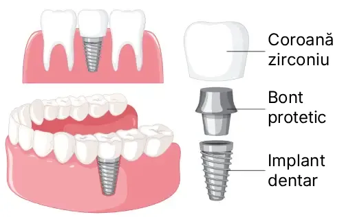 Oferta Implant Dentar Neobiotech