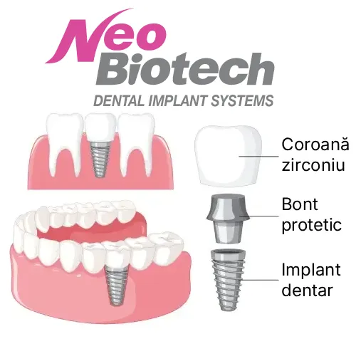 Oferta Implant Dentar Neobiotech